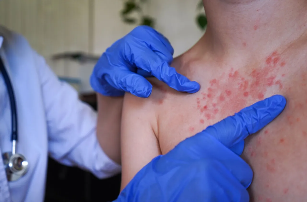 Изследват още деца от Врачанско за морбили